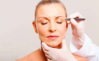 Donna con segni pre-operatori sul viso durante una visita per intervento di chirurgia estetica, primo piano medico-estetico